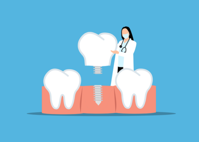 Comment prendre soin de ses implants dentaires