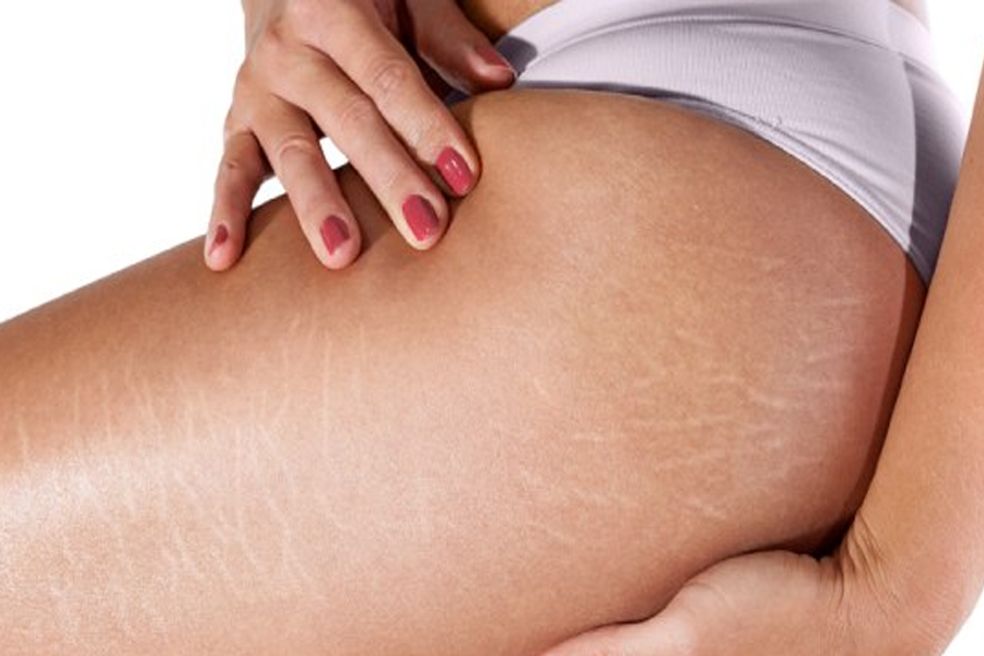 traitement des vergetures